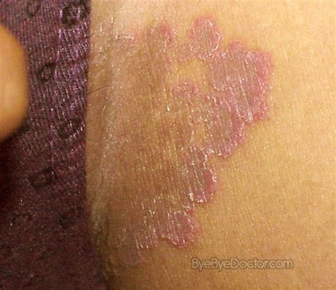 Inner Thigh Rash Pictures Causes And Treatment Std