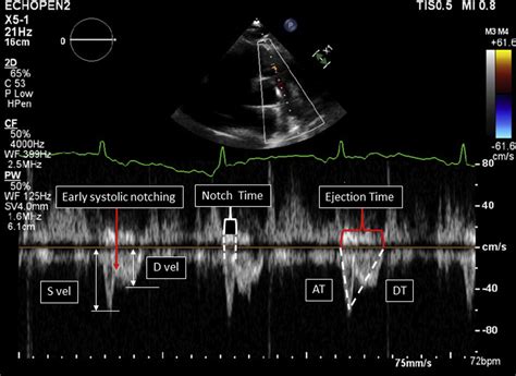 A Doppler Echocardiographic Pulmonary Flow Marker Of Massive Or