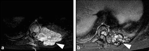 Combined Transarterial Embolization And Percutaneous Sclerotherapy As