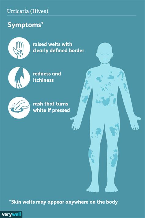 Urticaria Hives Signs Symptoms And Complications