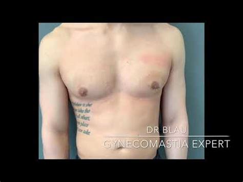 Amazing Results After Gynecomastia Surgery With Dr Blau Just Two Days