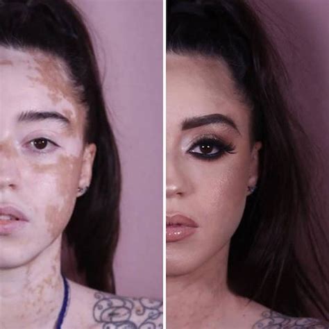 Girl With Vitiligo Show Her Beauty Through Modeling 19 Pics