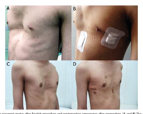 Figure From Modified Nuss Procedure In The Treatment Of Recurrent