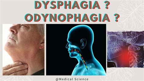 What Is Dysphagia Types Causes Diagnosis And Treatment Youtube