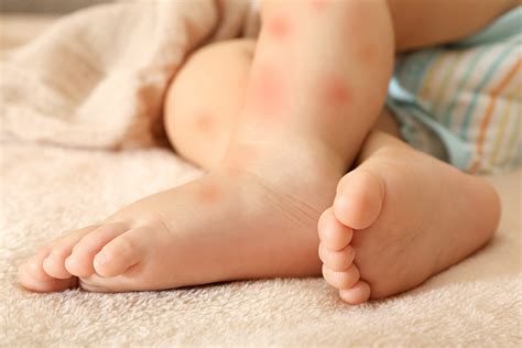 Alergia alimentaria en bebés Tu sala de Espera