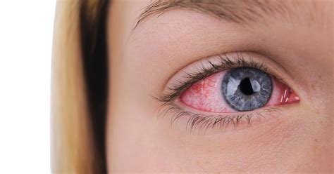 Eye Herpes Symptoms Causes Treatments