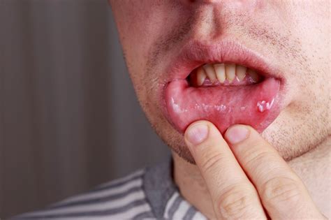 Ulceras Bucales ¿cómo Puedo Prevenirlas