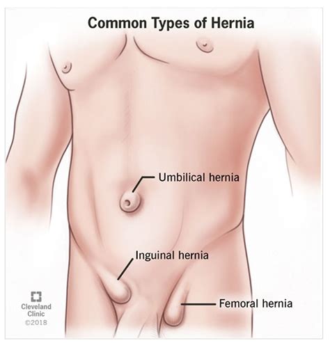 They are located in the thorax, either side of the mediastinum. Hernias Inguinales - Alayon Surgical
