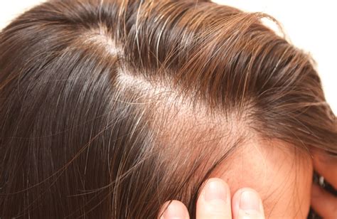 Alopecia Androgenética En Mujeres Causas Y Los Mejores Tratamientos