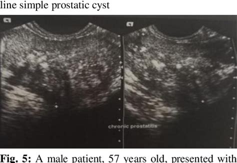Figure 1 From Role Of Trans Rectal And Scrotal Ultrasonography With