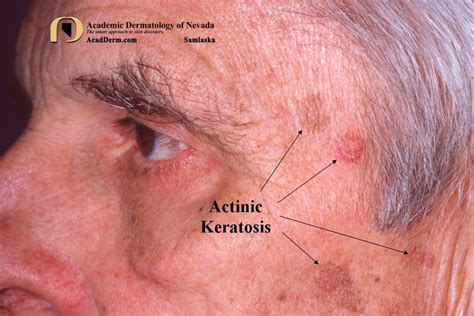 Actinic Keratosis Appearance Vs Squamous Cell Carcino