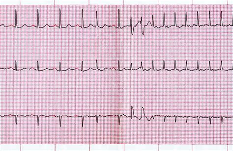 Most Common Ecg Abnormalities In Systemic Lupus Erythematosus The