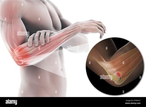 Ilustración del brazo con piel transparente para mostrar lesiones de