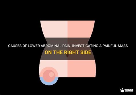 Causes Of Lower Abdominal Pain Investigating A Painful Mass On The Right Side Medshun