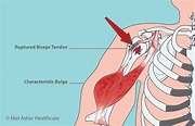 The LHB (Biceps Tendinitis -Long Head Biceps) is unique in that it ...