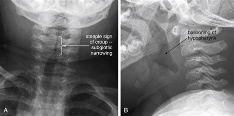 Imaging Soft Tissues Of The Neck Radiology Key