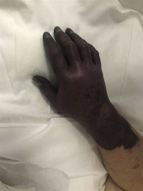 Pain Swelling And Blue Discoloration Of Right Hand In A Covid 19