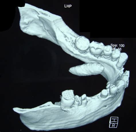 Unusual Large Submandibular Gland Calculus Dental News