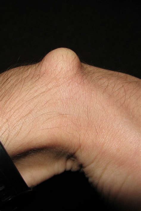 Ganglion Cyst Symptoms Causes And Treatment
