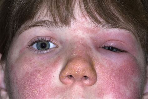 Derm Dx An 8 Year Old Girl With A Swollen Red Eyelid Accompanied By An