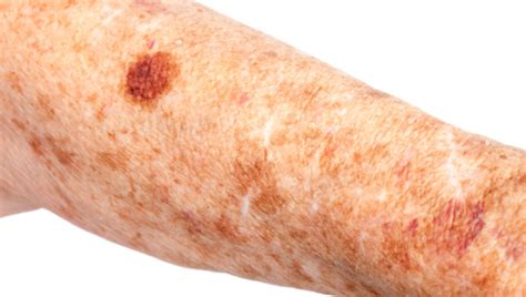 Actinic Keratosis Causes Symptoms And Treatment