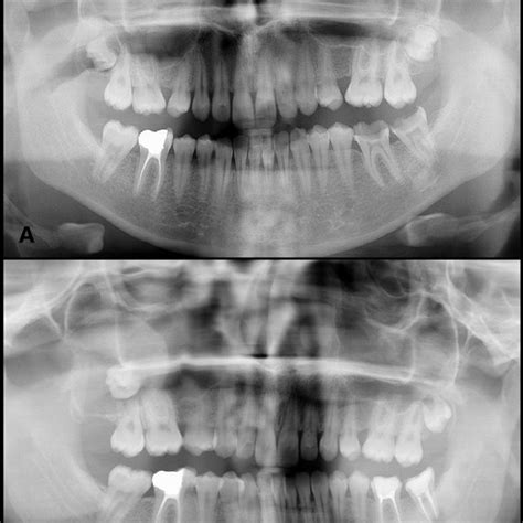Facial Asymmetry Due To Swelling Of The Right Maxillary Sinus