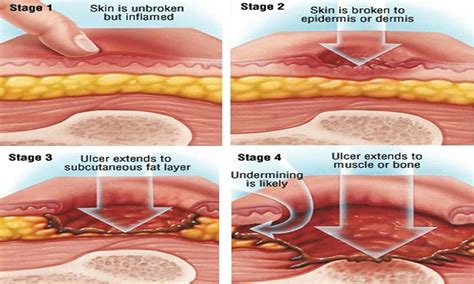 Bed Sores Pressure Ulcer Causes Stages Prevention Pressure Ulcer Treatment