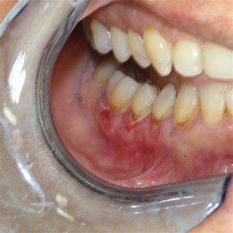 Localized Erythroleukoplakia On The Buccal Gingiva Of Teeth 44 47