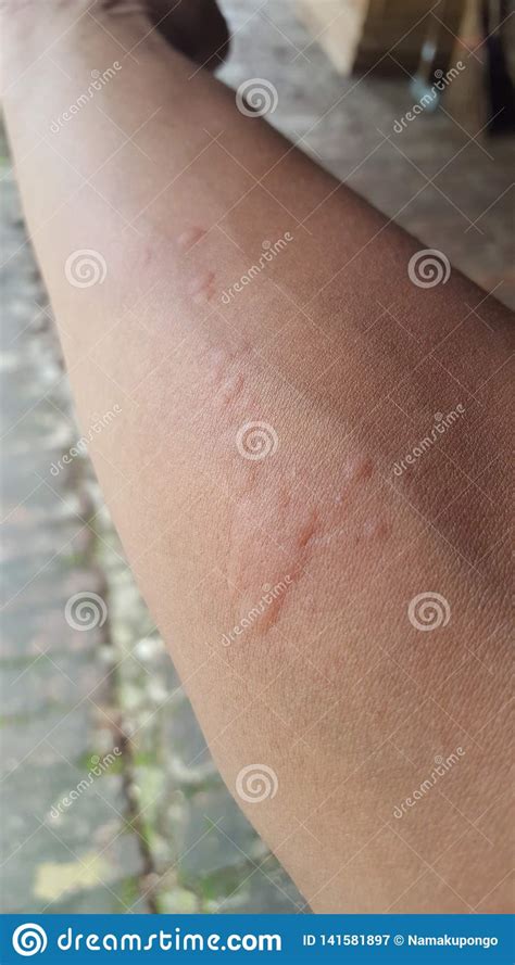 Itchy Bumps On The Skin Due To Insect Bitesitchy Bumps On The Skin Due