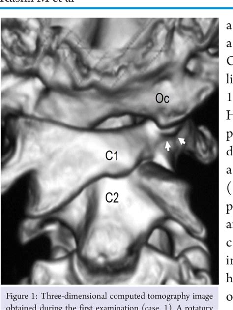 Figure 1 From Rotatory Subluxation And Facet Deformity In The Atlanto