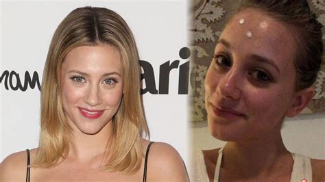 23 Celebrities Who Suffer Acne Breakouts And Skin Problems