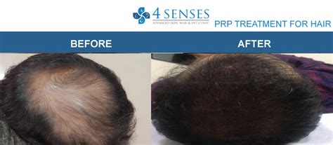 Prp Hair Loss Treatment In Bangalore Prp Treatment