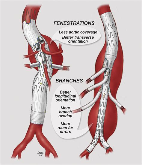 Results Of Fenestrated And Branched Endovascular Aortic Aneurysm Repair