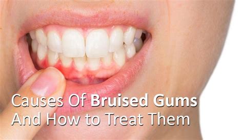 Causes Of Bruised Gums And How To Treat Them
