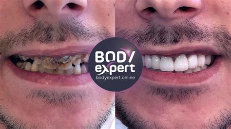 Couronnes dentaire Avant Après résultats après la pose Body Expert