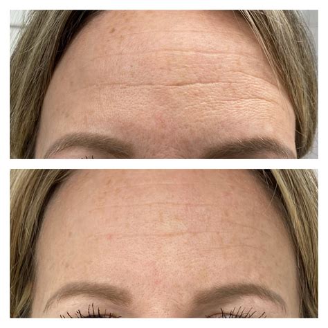 microneedling before and after results nikki butler skin specialist in hampshire