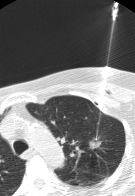 Complications Of Ct Guided Percutaneous Needle Biopsy Of The Chest
