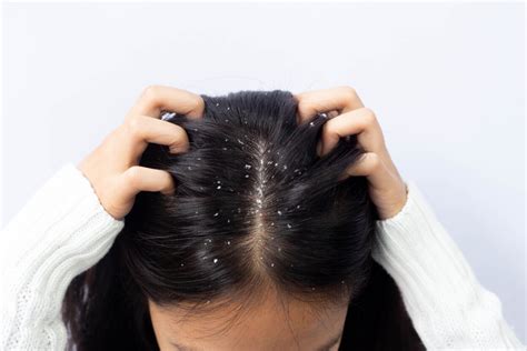 How To Treat And Heal Scabs On Scalp From Bleach Gentle Care Guide
