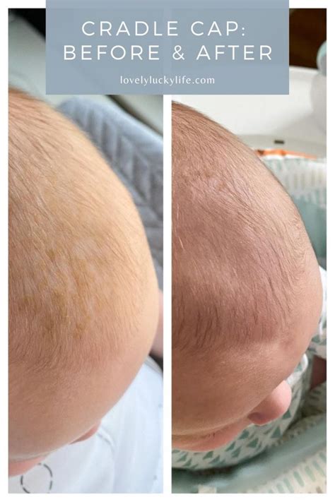 How To Get Rid Of Cradle Cap Naturally Lovely Lucky Life