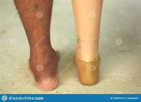 False Legs For Amputated Persons Stock Image Image Of Help Hand