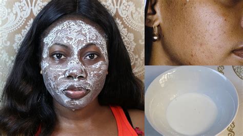 How To Get Rid Of Whiteheads At Home In 7 Days Youtube