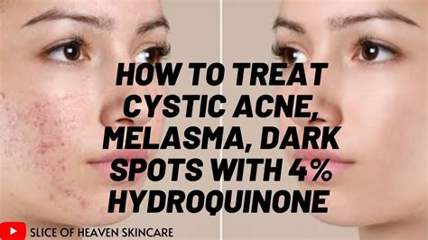 How To Treat Cystic Acne Acne Scarring And Hyperpigmentation Using