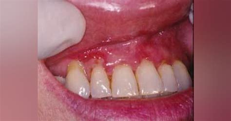 Mucous Membrane Pemphigoid Registered Dental Hygienists