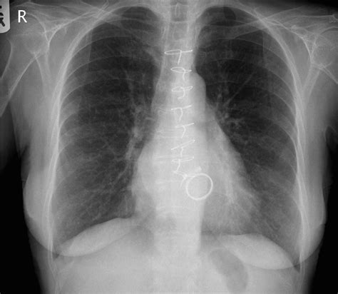 Mitral Valve Anatomy