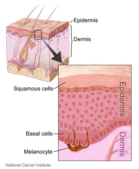 What Is The Difference Between Basal Cell And Squamous Cell Pediaacom