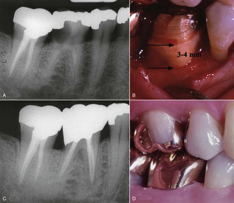 Isolation Endodontic Access And Length Determination Pocket Dentistry
