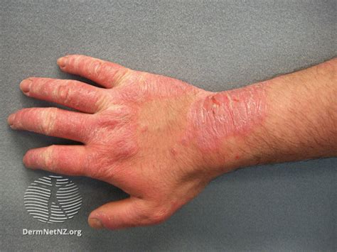 Contact Dermatitis The London Skin And Hair Clinic