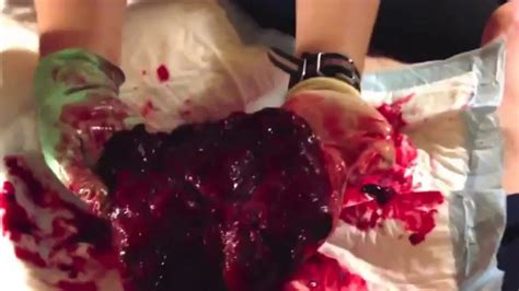 Recent advances in understanding evolution of the placenta: Henry's Partial Circumvallate Placenta - YouTube