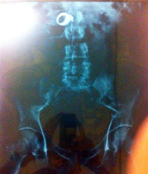 Real X Rays That Will Shock And Astound You Pics Izismile Com