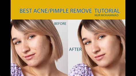 Acne Remove How To Remove Acne Photoshopremove Pimple Tutorial